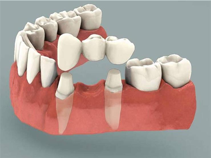 الفرق بين زرع وتركيب الاسنان