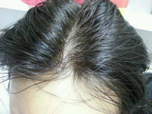 تجربتي في زراعة الشعر للنساء